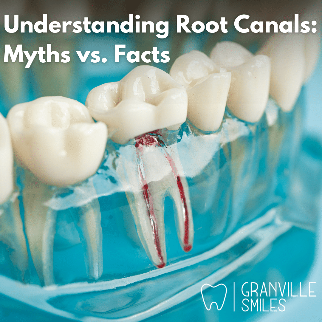 root canals