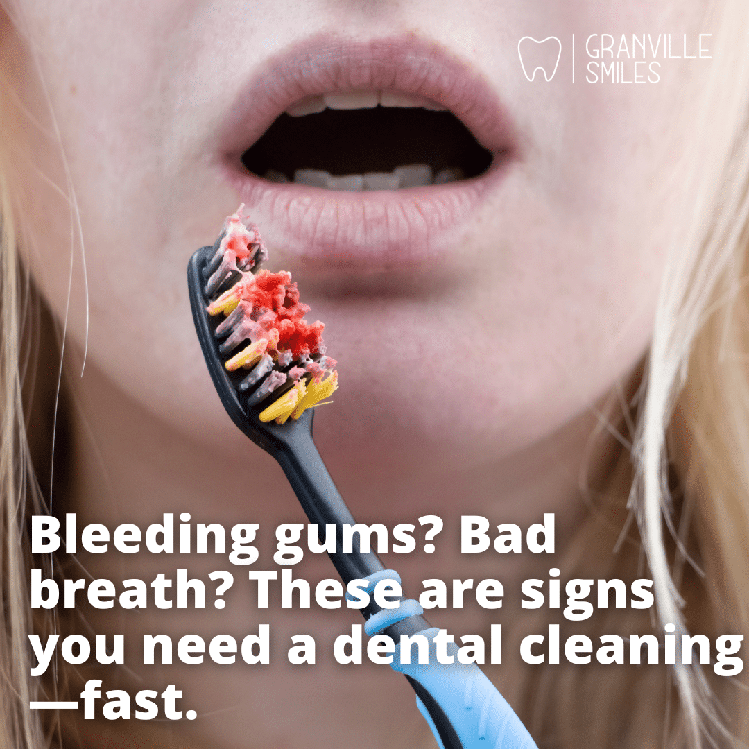dental cleaning